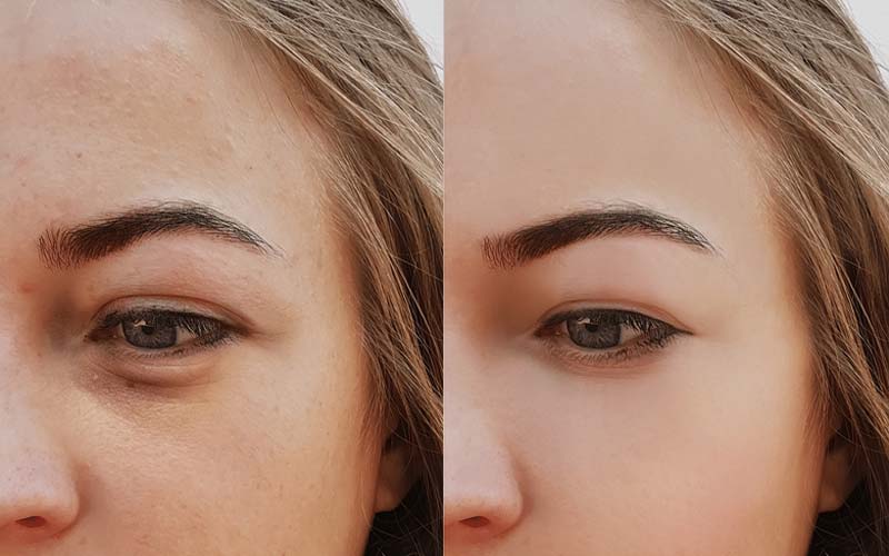 کربوکسی تراپی برای سیاهی زیر چشم